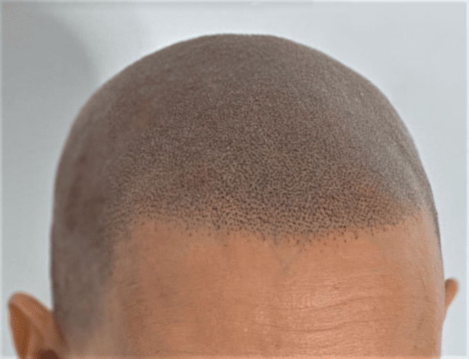 micro pigmentation capillaire effet rasé tricho pigmentation daena aesthetic concept