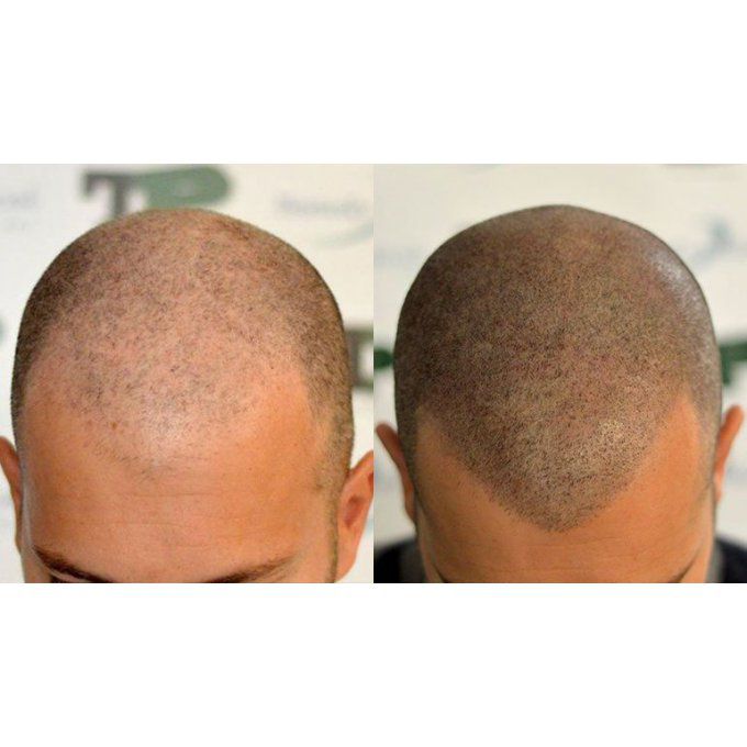 micro pigmentation capillaire effet rasé tricho pigmentation daena aesthetic concept